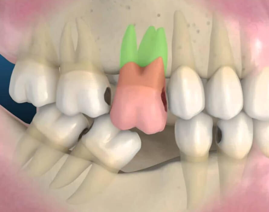 consequencia-falta-dente-1.jpg